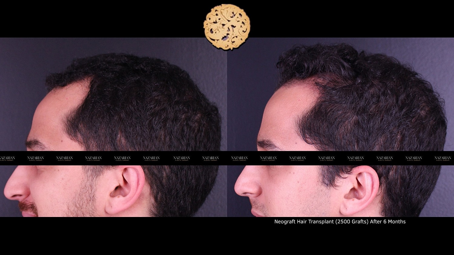 Before and after hair transplant results comparison.