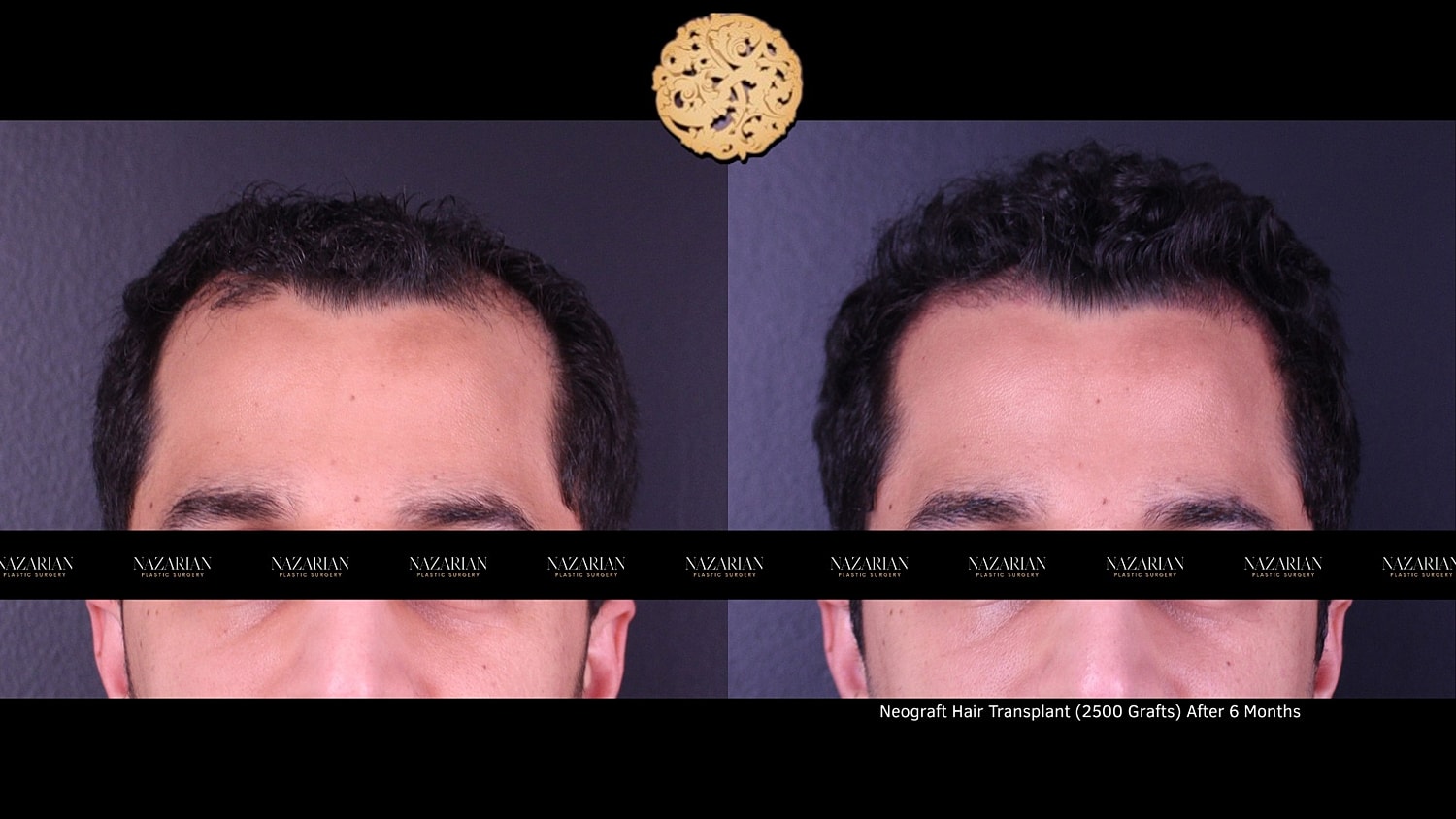 Hair transplant results before and after comparison.