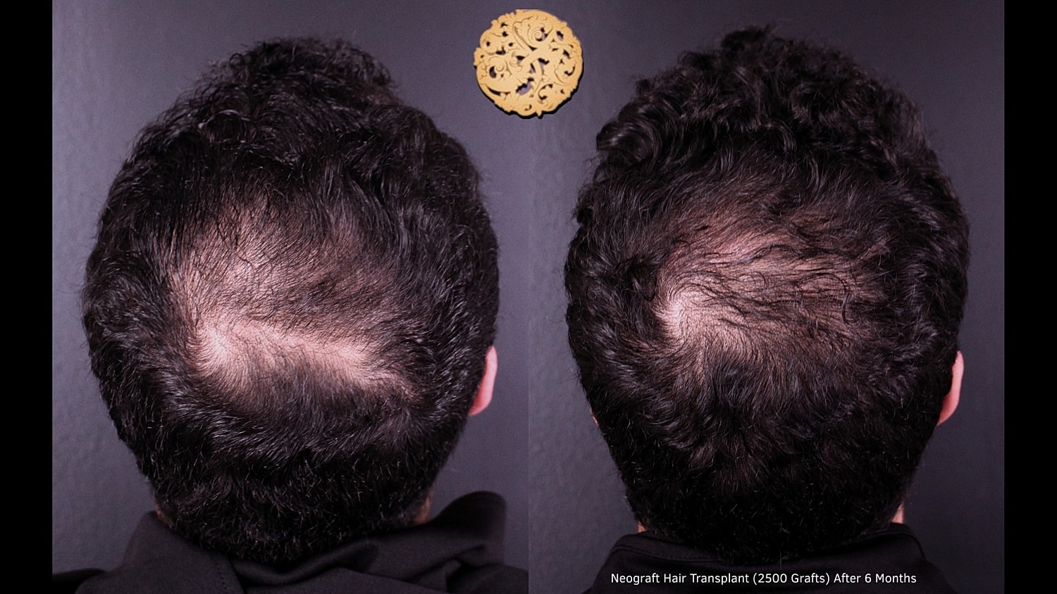 Before and after hair transplant comparison.