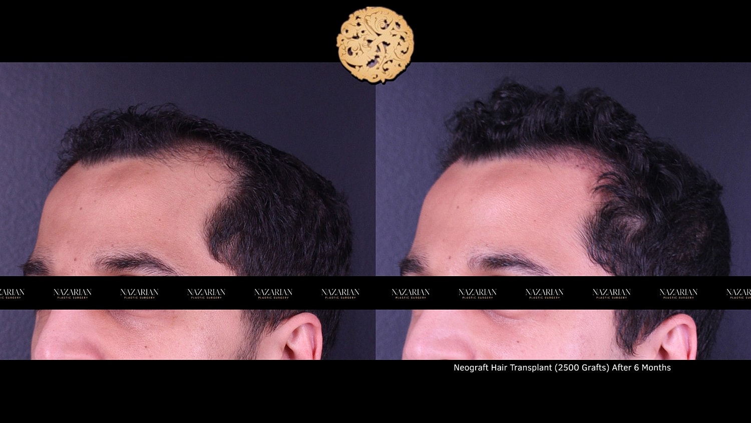 Hair transplant results after six months comparison.