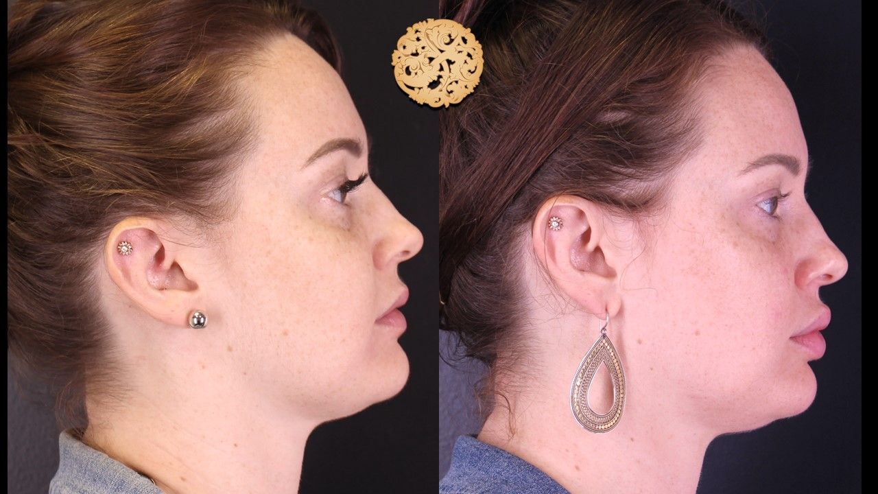 Dermaplane Before & After