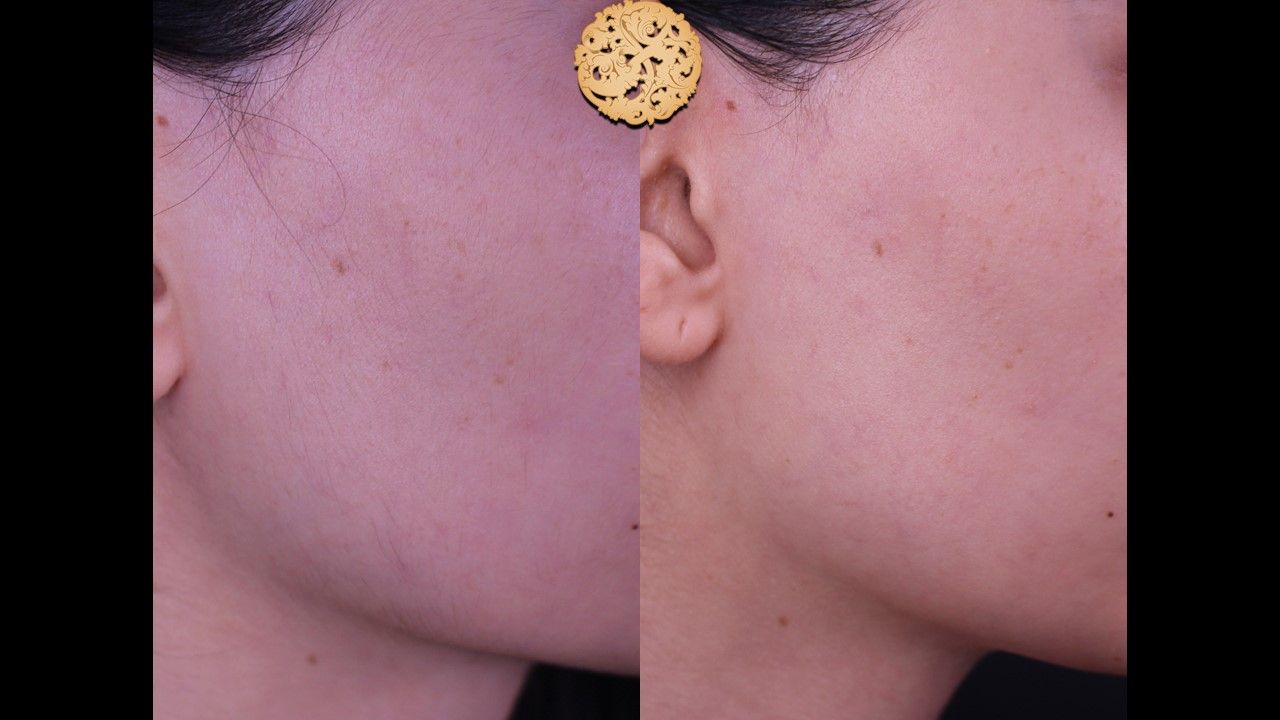 Dermaplane Before & After