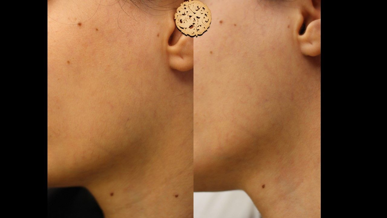 Dermaplane Before & After