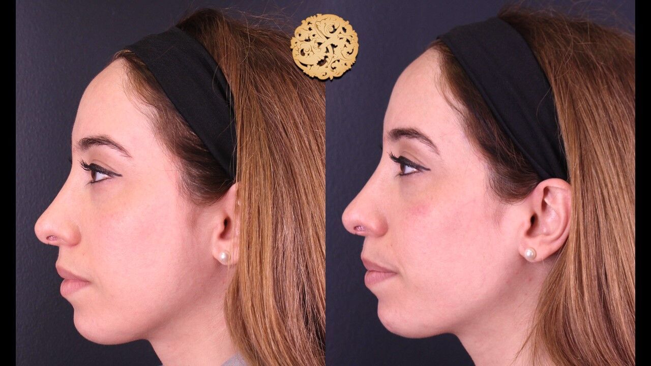 Cheek Filler Before & After
