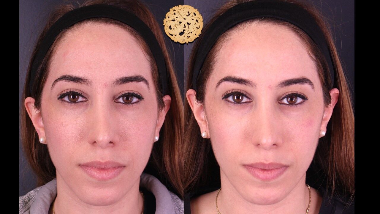 Cheek Filler Before & After