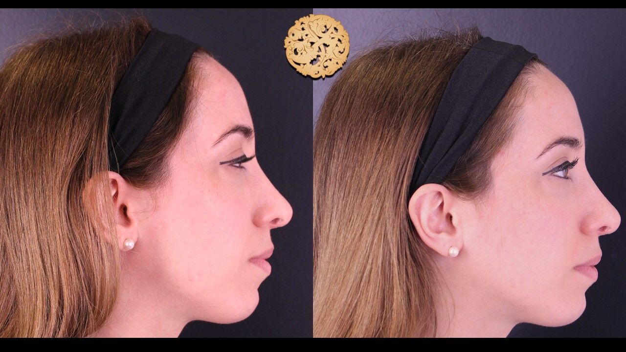 Cheek Filler Before & After