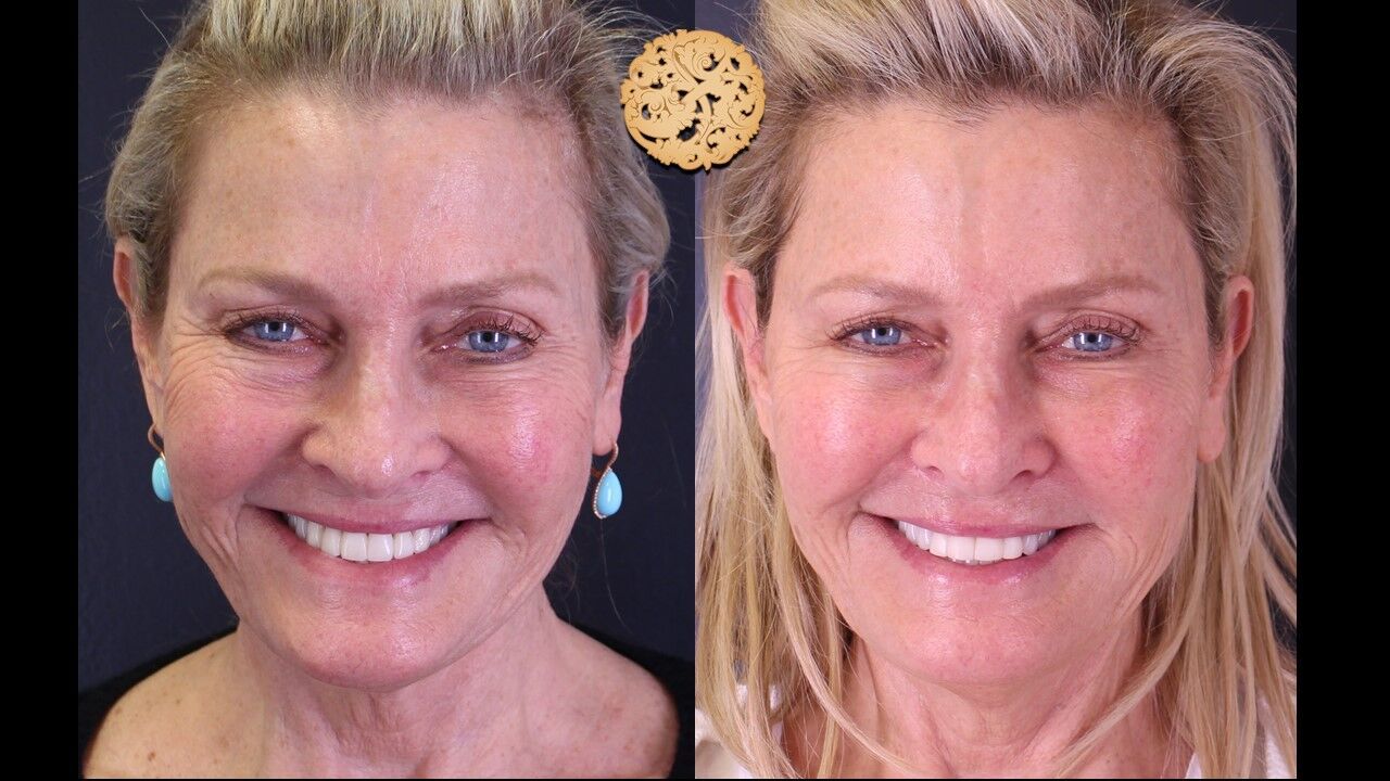 Cheek Filler Before & After