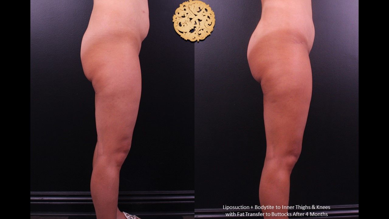 Fat Transfer Buttocks Before & After