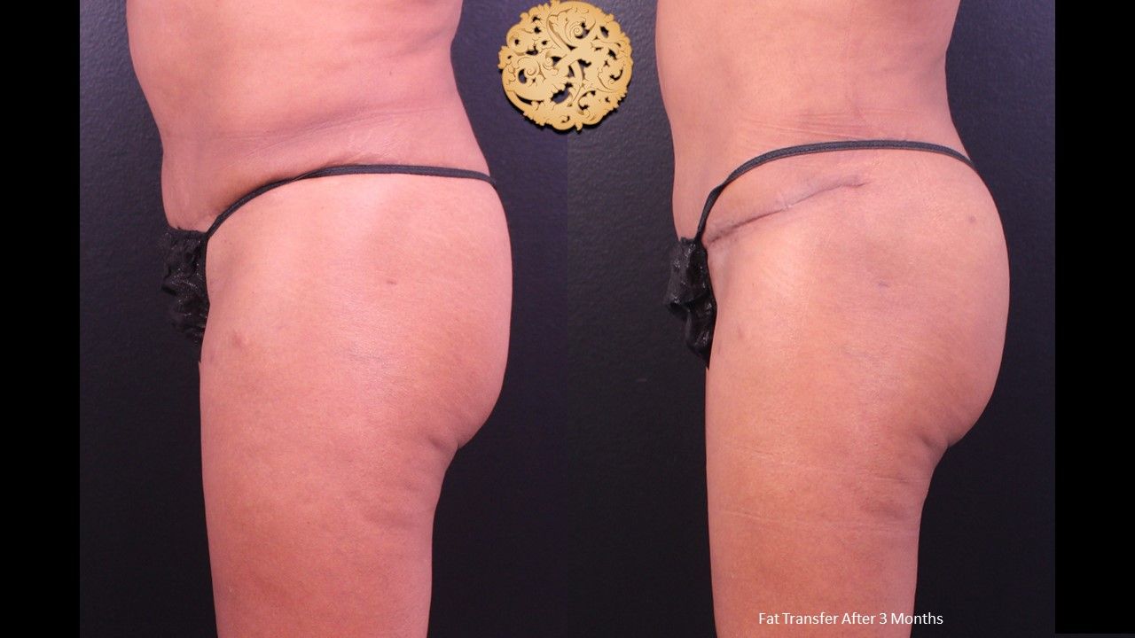 Fat Transfer Buttocks Before & After