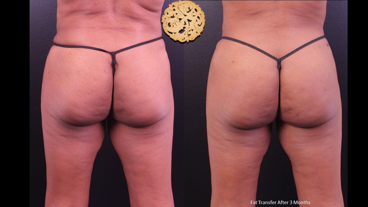 Fat Transfer Buttocks Before & After