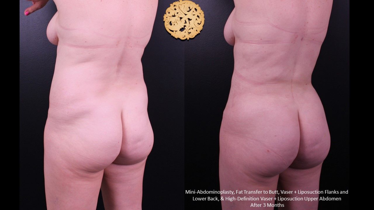 Fat Transfer Buttocks Before & After