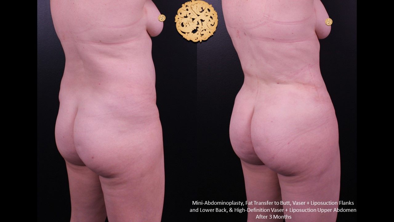 Fat Transfer Buttocks Before & After
