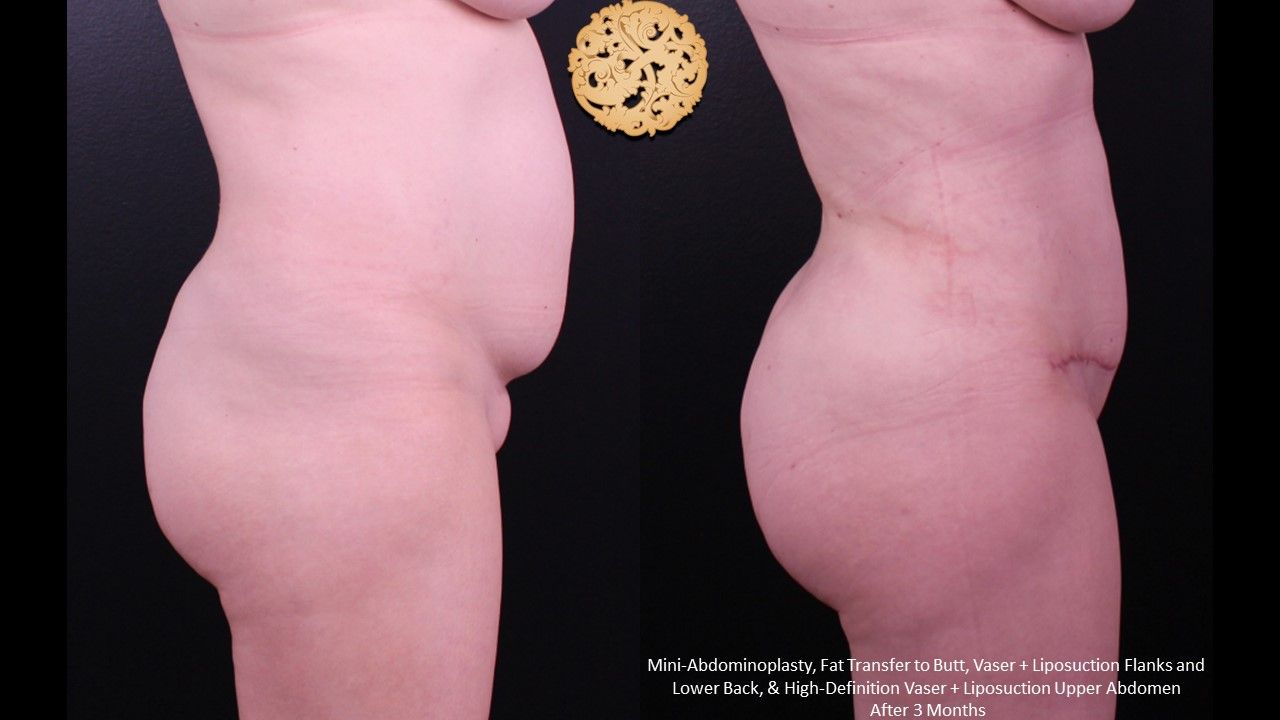 Fat Transfer Buttocks Before & After