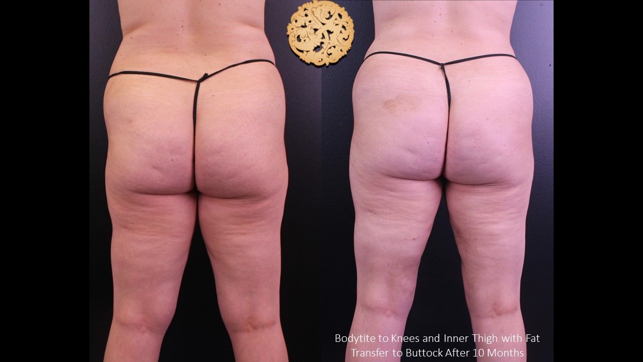 Fat Transfer Buttocks Before & After