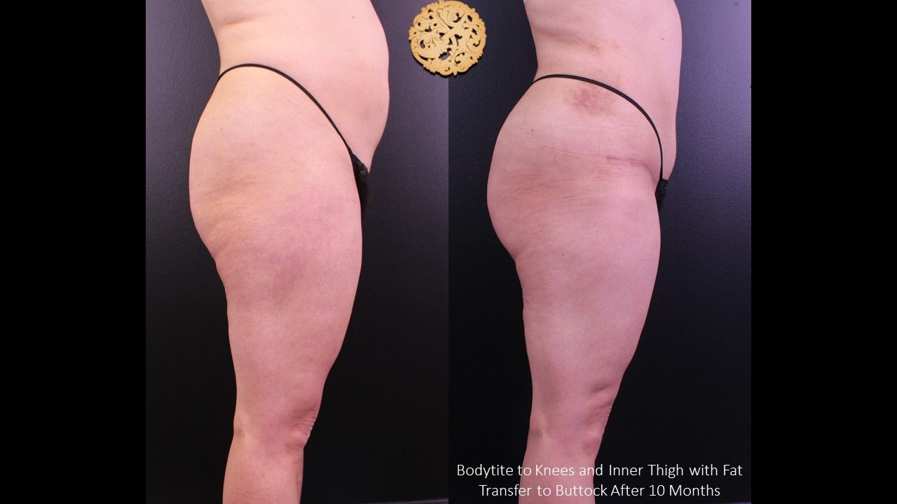 Fat Transfer Buttocks Before & After