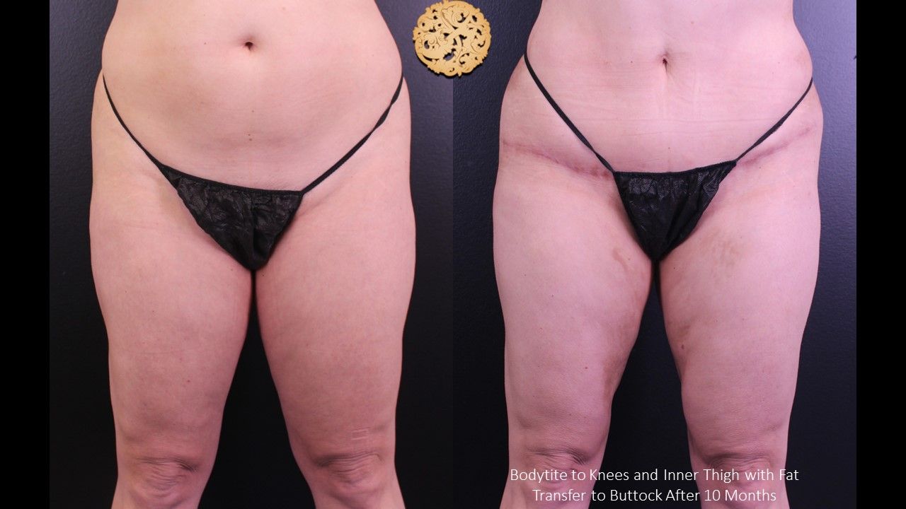 Fat Transfer Buttocks Before & After