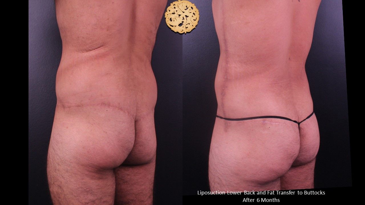 Fat Transfer Buttocks Before & After