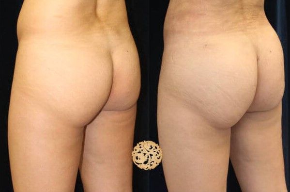 Fat Transfer Buttocks Before & After