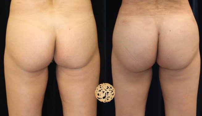 Fat Transfer Buttocks Before & After