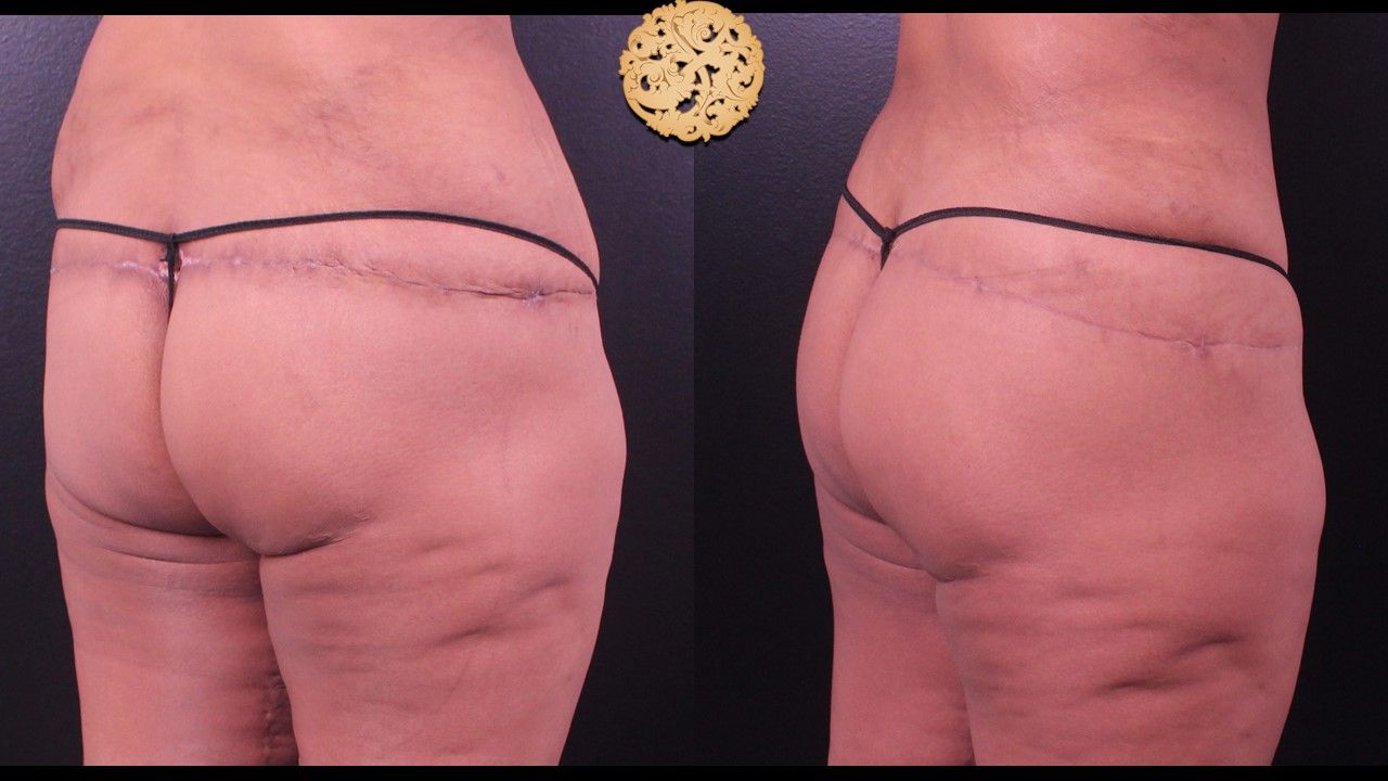 Fat Transfer Buttocks Before & After