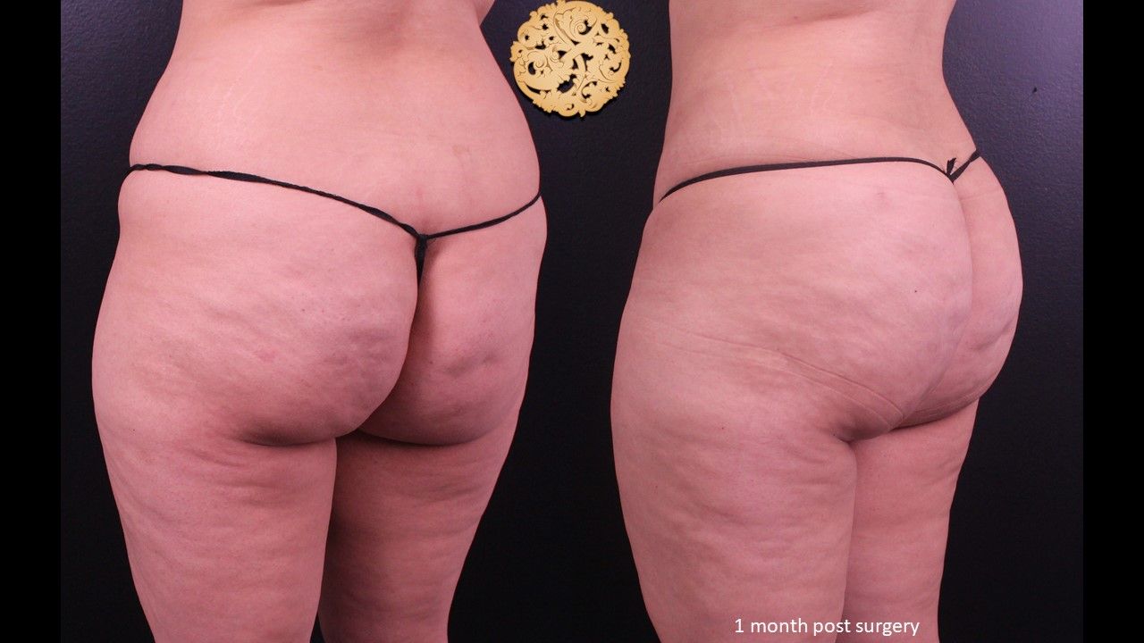 Fat Transfer Buttocks Before & After