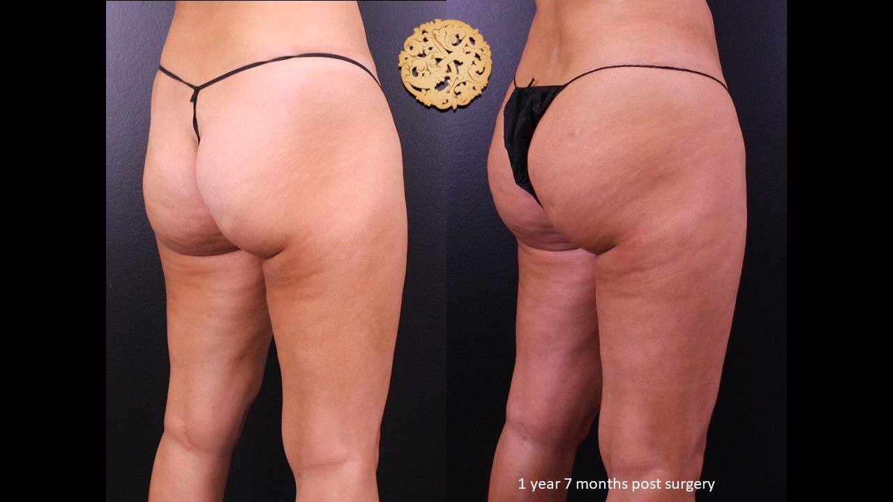 Fat Transfer Buttocks Before & After