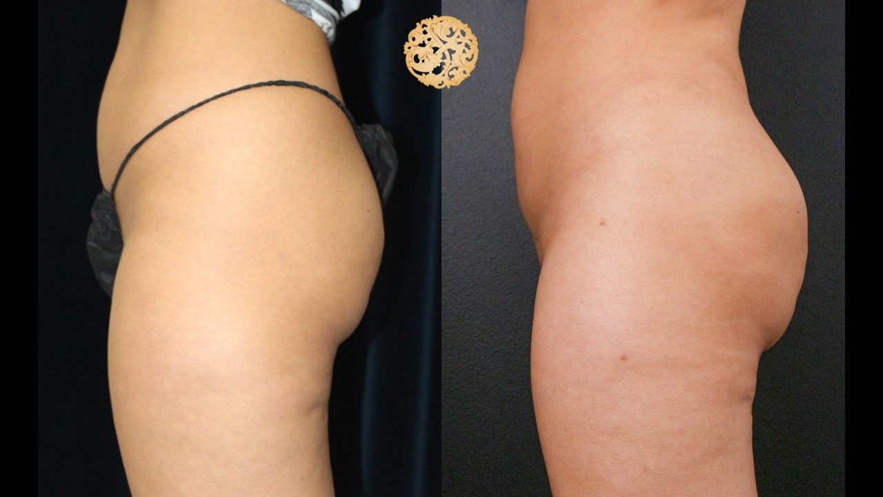 Fat Transfer Buttocks Before & After