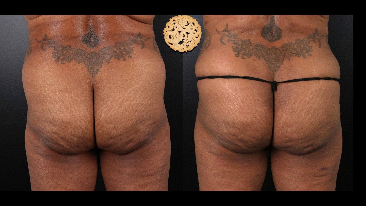 Fat Transfer Buttocks Before & After
