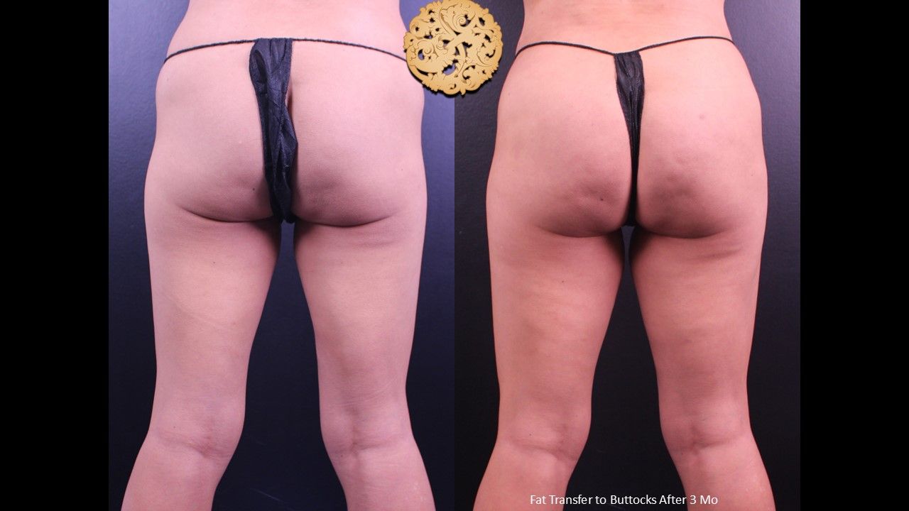 Fat Transfer Buttocks Before & After