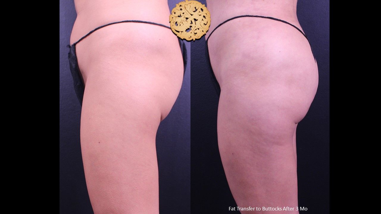 Fat Transfer Buttocks Before & After
