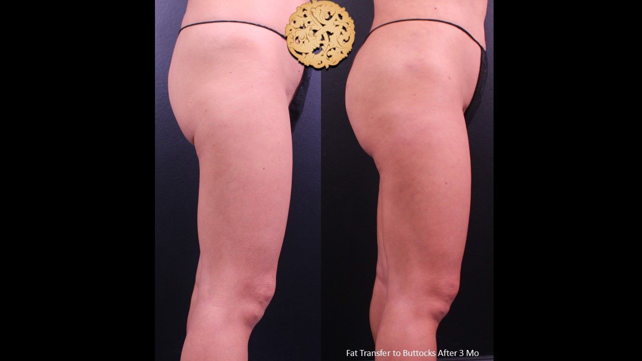 Fat Transfer Buttocks Before & After