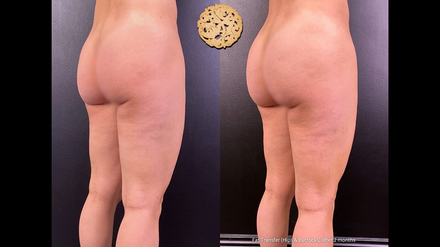 Fat Transfer Buttocks Before & After