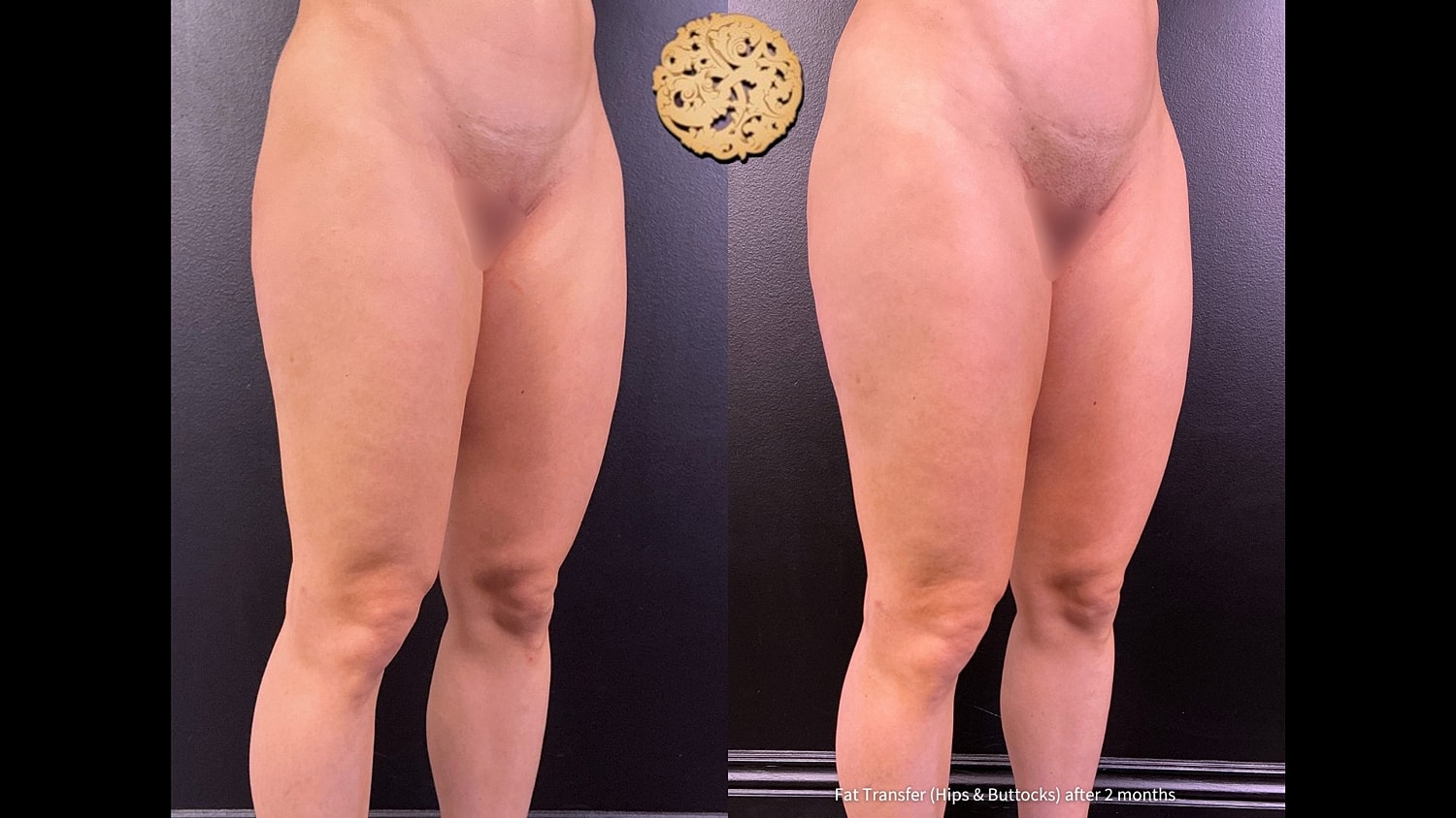 Fat Transfer Buttocks Before & After