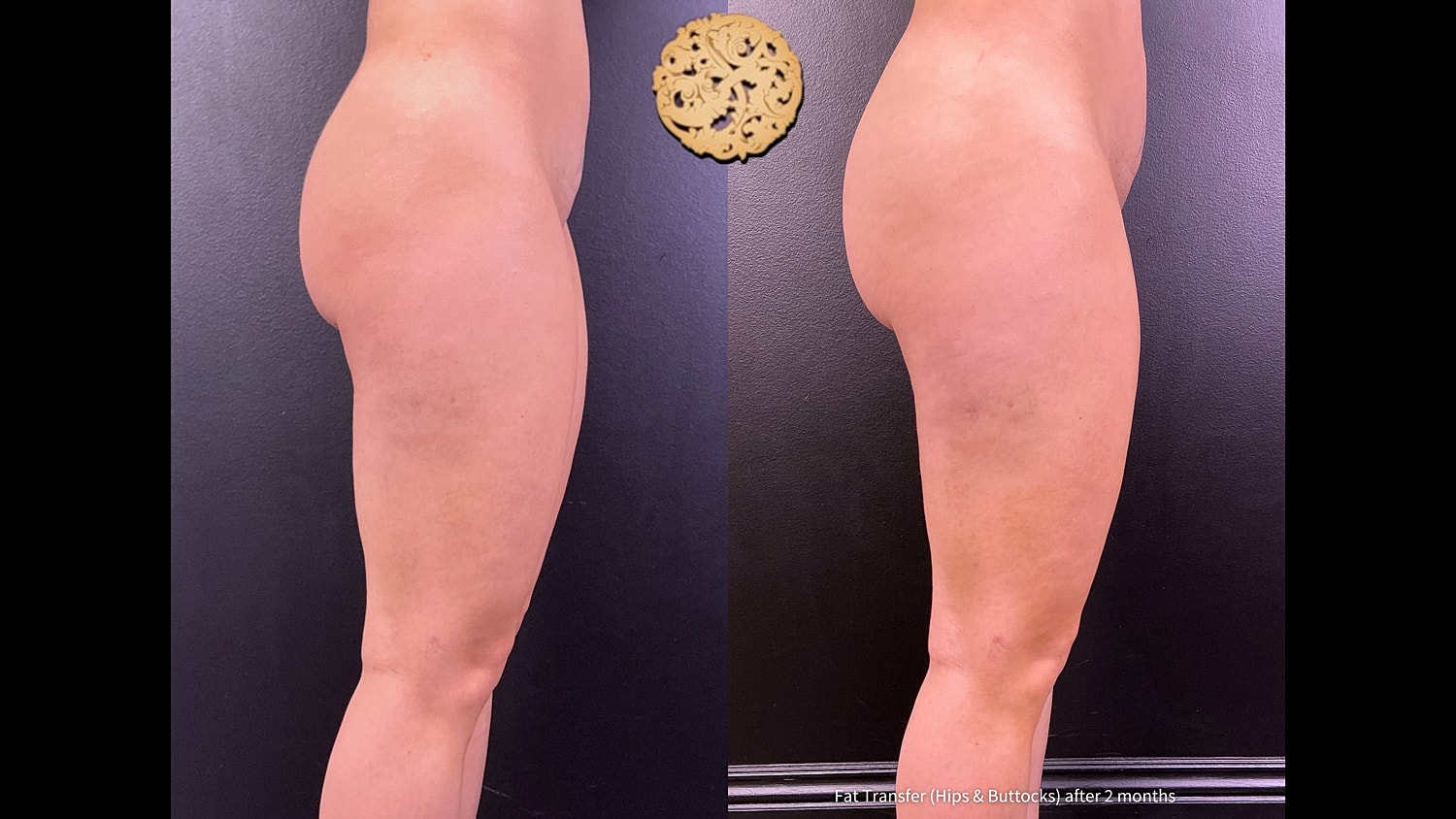 Fat Transfer Buttocks Before & After