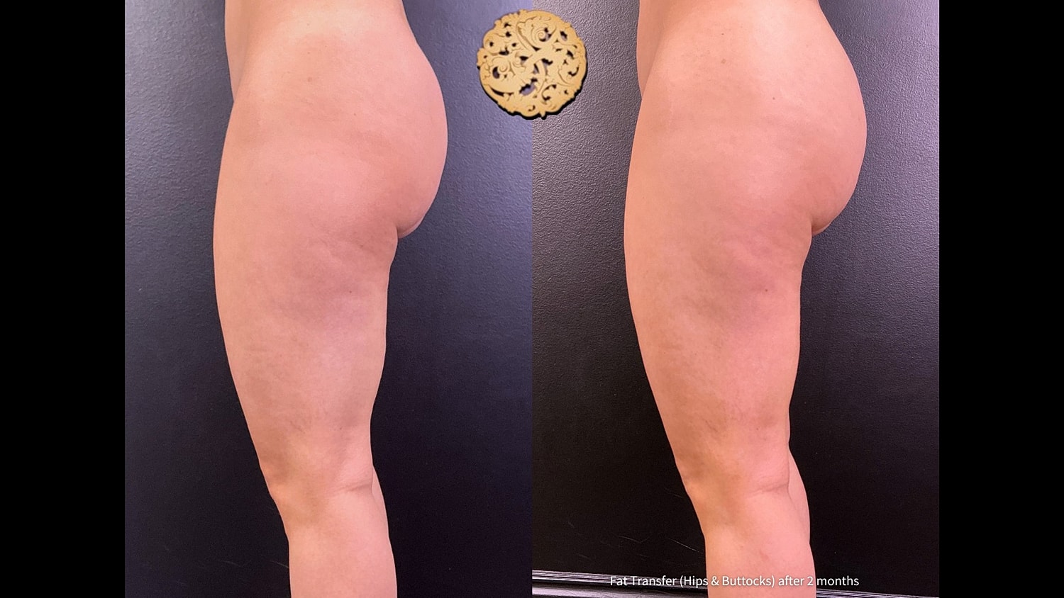 Fat Transfer Buttocks Before & After