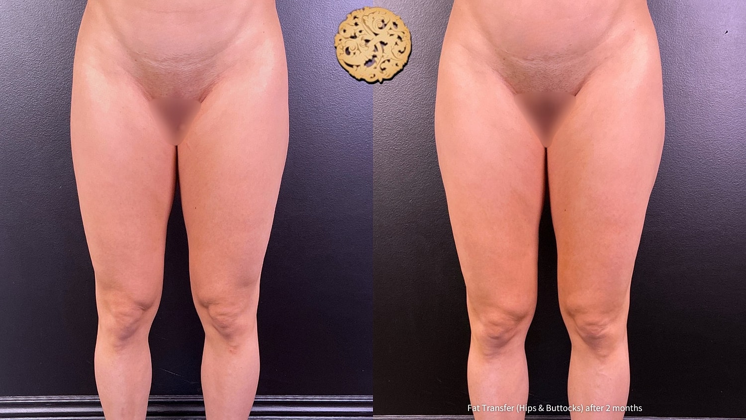 Fat Transfer Buttocks Before & After