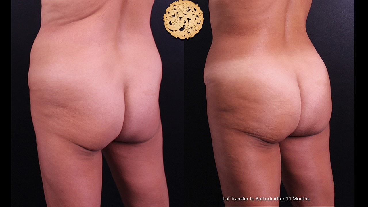 Before and after fat transfer to buttocks.