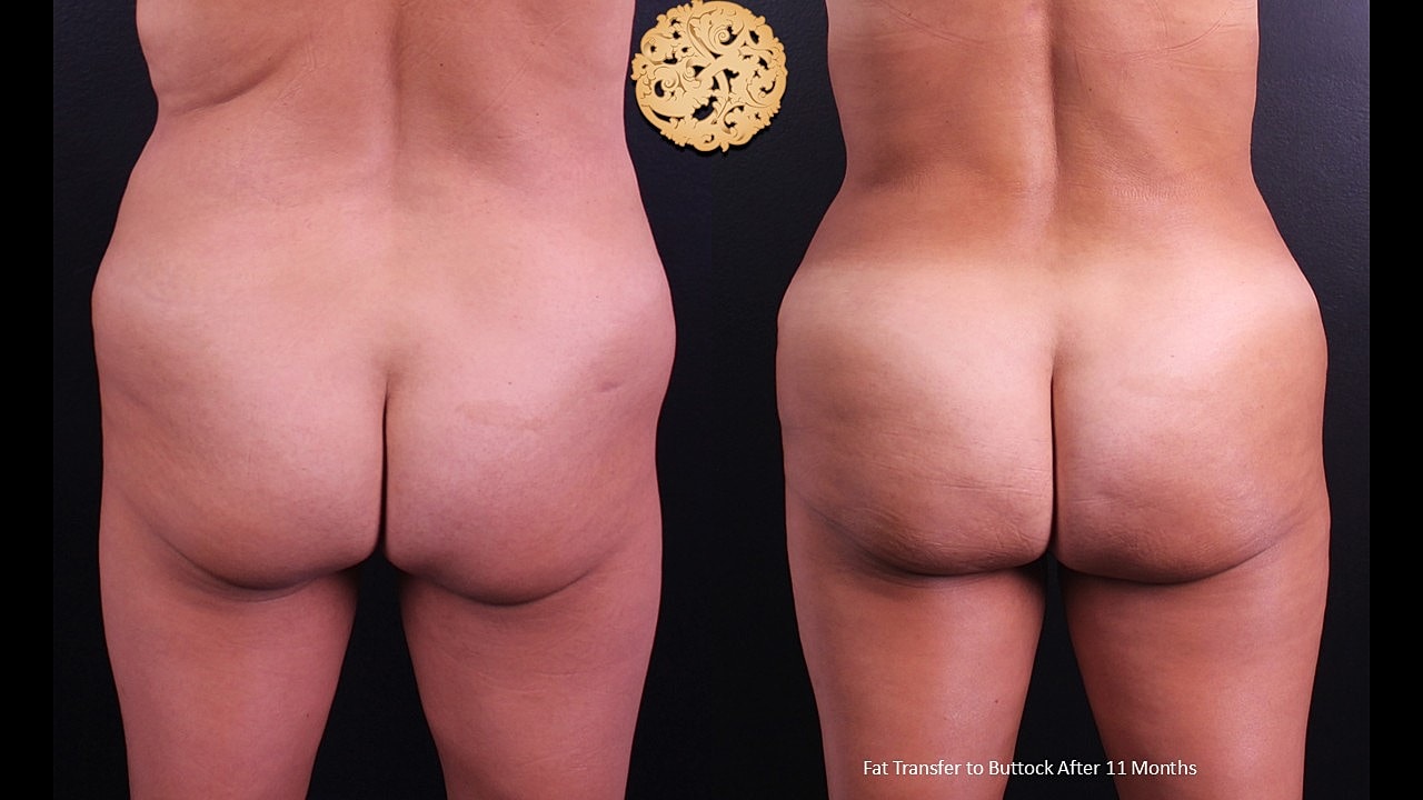 Before and after buttock fat transfer results.
