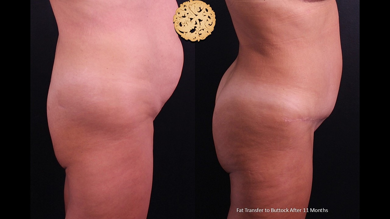 Before and after fat transfer to buttocks.