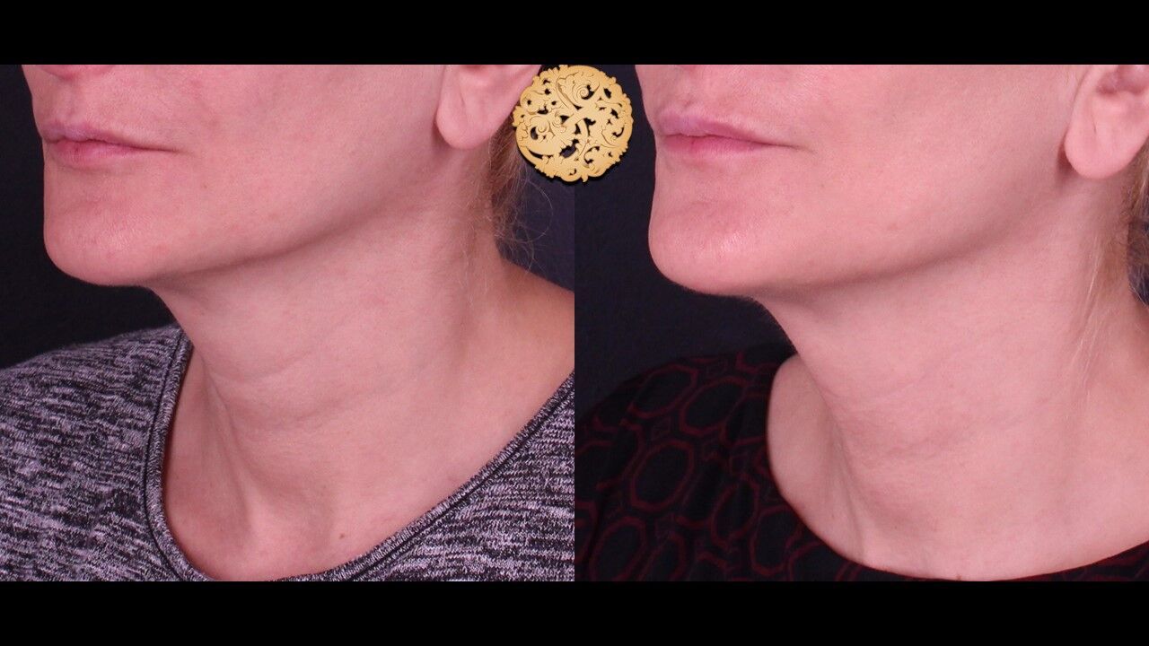 Neck Filler Before & After