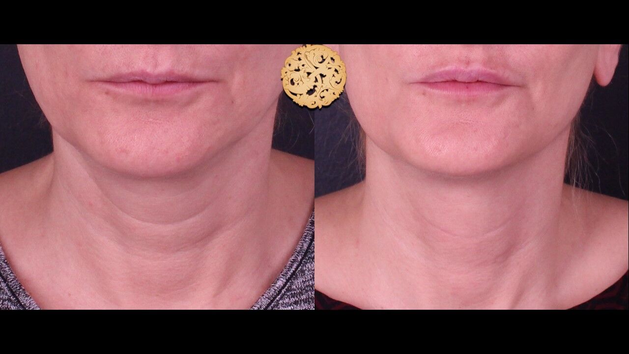Neck Filler Before & After