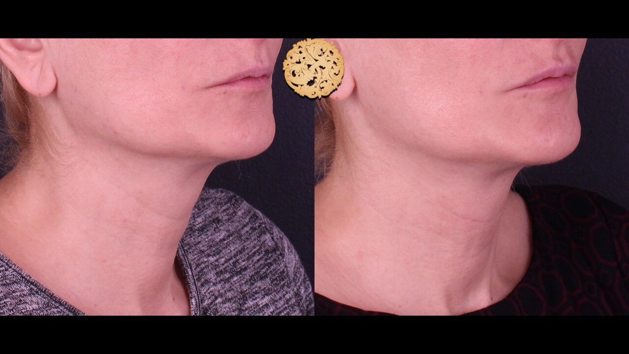 Neck Filler Before & After