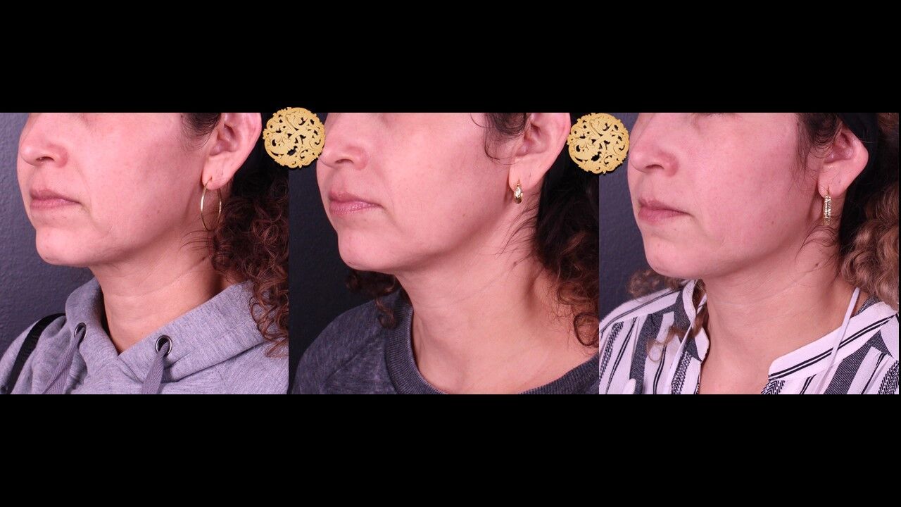 Neck Filler Before & After