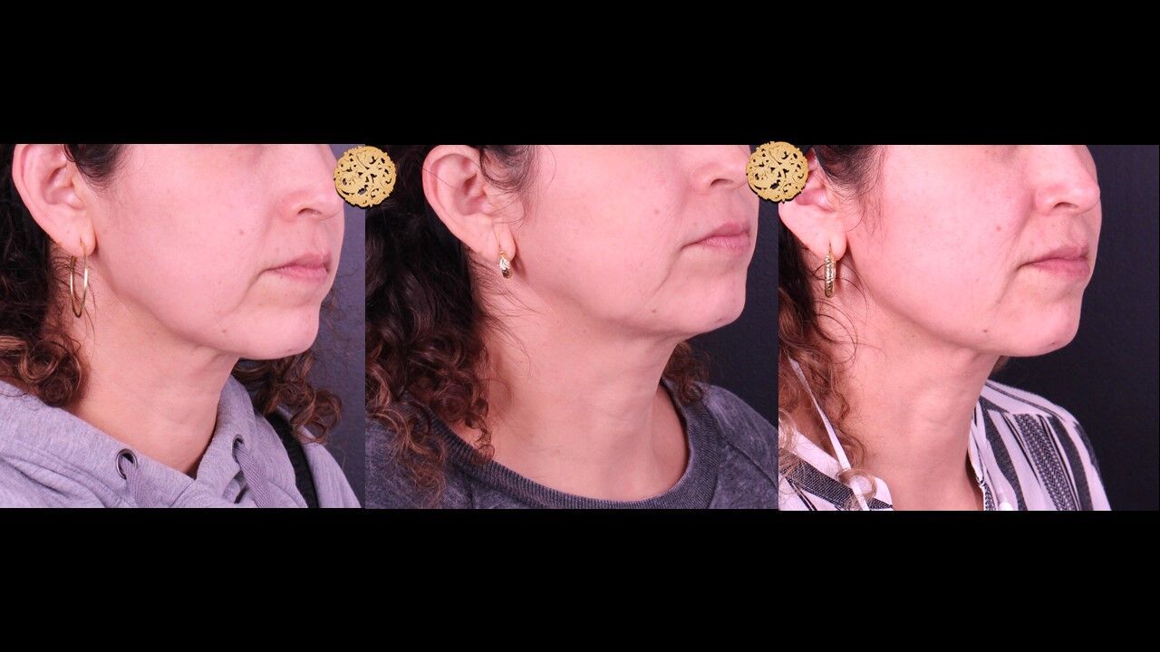 Neck Filler Before & After