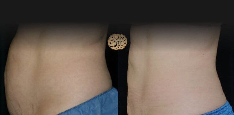 Abdomen Coolsculpting Before & After