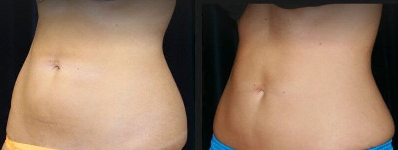 Abdomen Coolsculpting Before & After