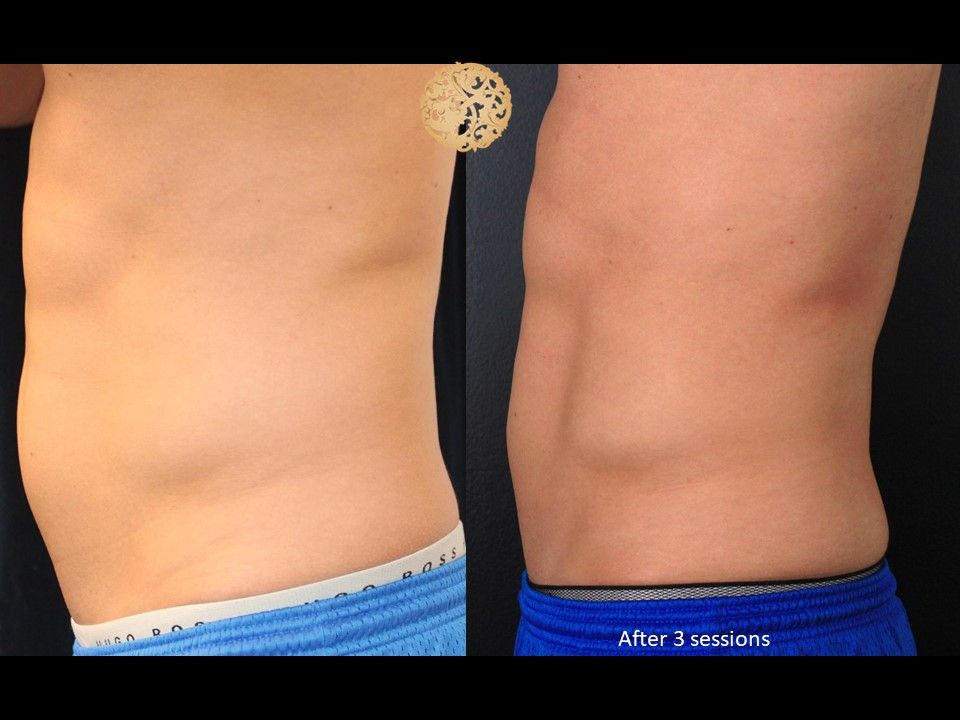 Abdomen Coolsculpting Before & After