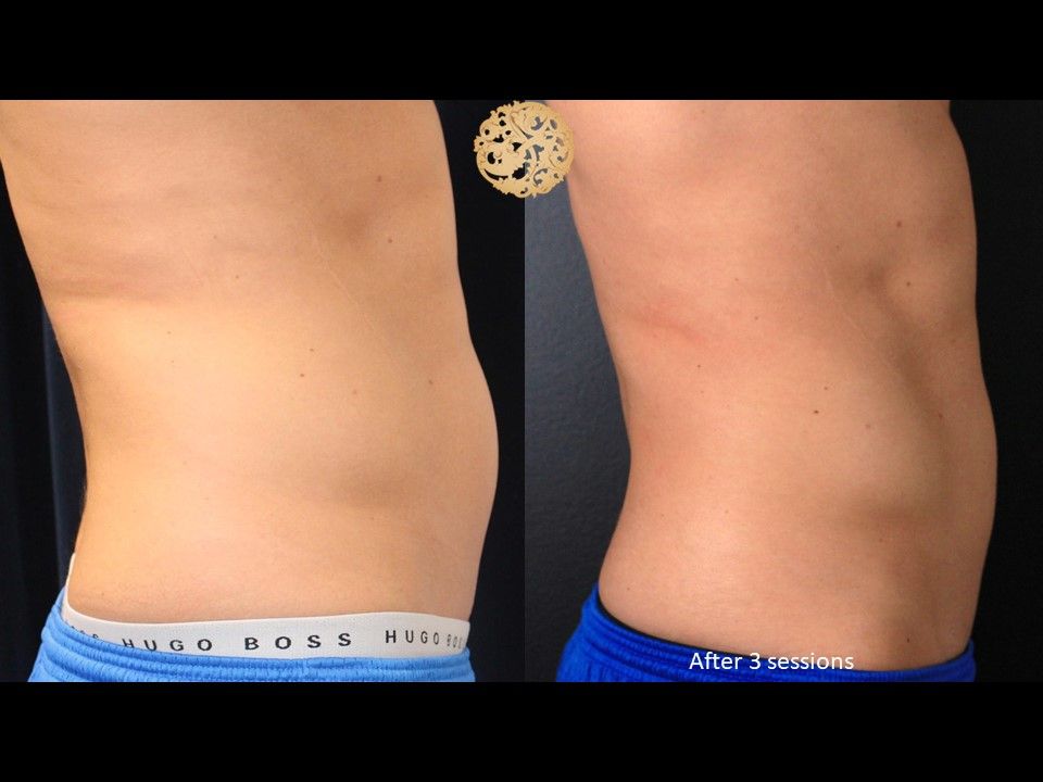 Abdomen Coolsculpting Before & After