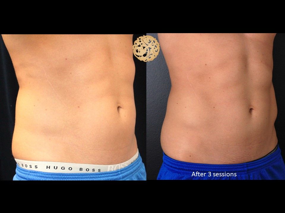 Abdomen Coolsculpting Before & After