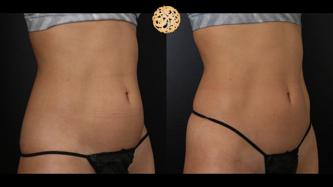 Abdomen Coolsculpting Before & After